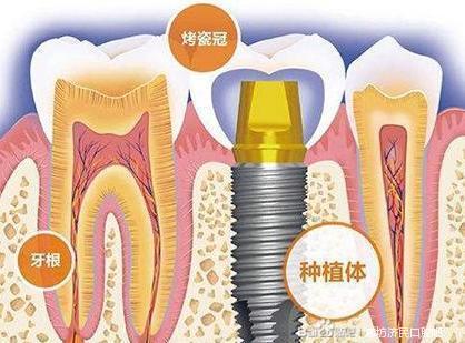 廊坊的种植牙组成部分你了解吗