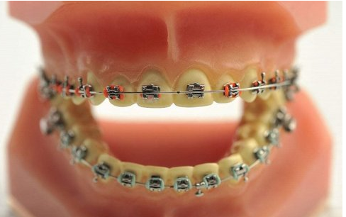 廊坊人的牙齿畸形是遗传还是后天造成的？