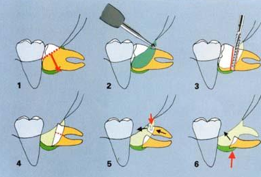 廊坊人，阻生牙需尽快拔除，否则危害大