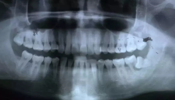 廊坊人，阻生牙需尽快拔除，否则危害大