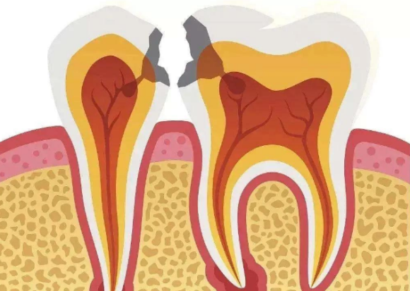 在廊坊，小孩也需要使用牙线吗？