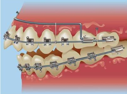 廊坊人牙齿矫正多久能有变化