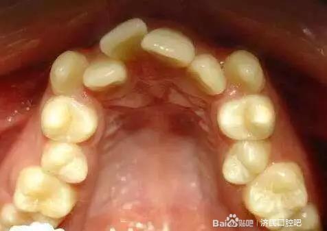 在廊坊，这种情况下，孩子的牙颌畸形要早治疗！