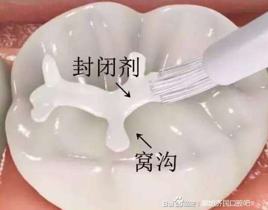 廊坊孩子的乳牙迟早要换，烂了也没事？