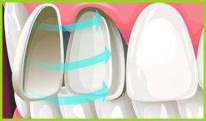 廊坊人的瓷贴面牙齿