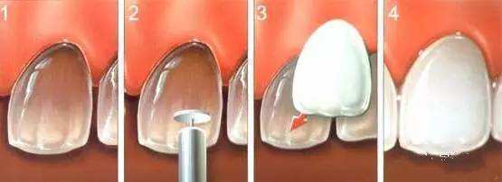 廊坊人的瓷贴面牙齿