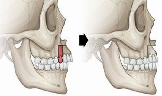 在廊坊，龅牙会遗传，是真的吗？