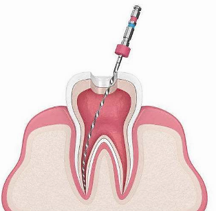 在廊坊，牙齿做了根管治疗后，还能用多久？