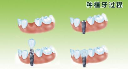 廊坊种植牙贵吗