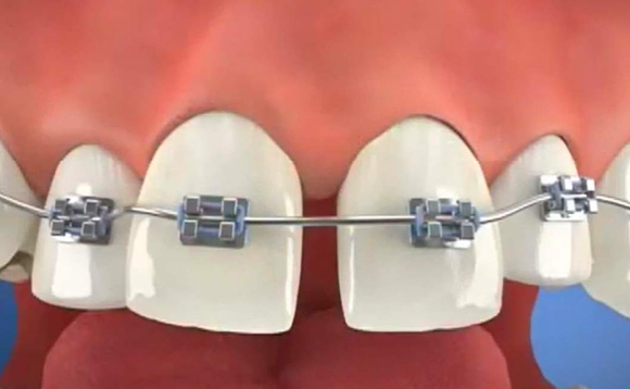 廊坊人牙齿缝隙越来越大怎么办