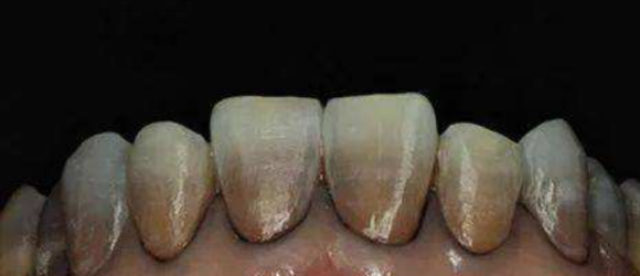 在廊坊，为什么牙齿会变色，变黄，变黑？