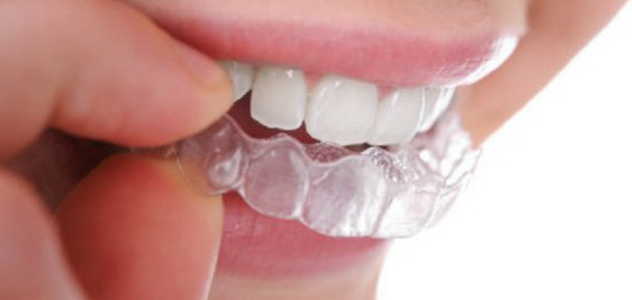 在廊坊，矫正后的所有顾虑，一篇帮你解答完！