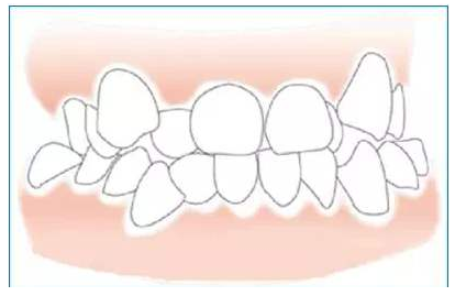 在廊坊，牙齿矫正可以不带钢丝牙套吗？
