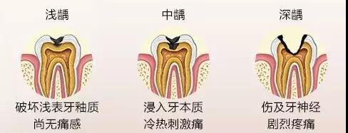 关于蛀牙你不得不知道的几点