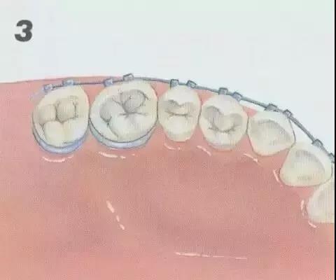 牙齿矫正原理，一根弓丝的力量有多强大？！