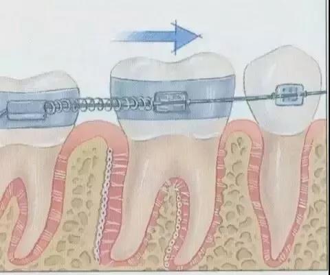 牙齿矫正原理，一根弓丝的力量有多强大？！