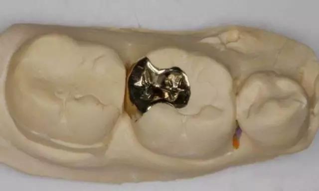 为什么补牙的材料会容易脱落?