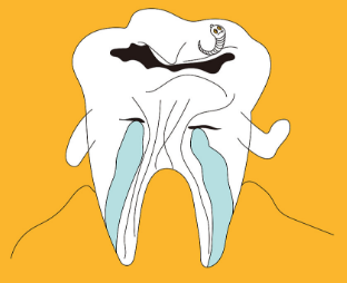 蛀牙应该怎么治疗？