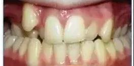 牙齿畸形，凸嘴该如何矫正？