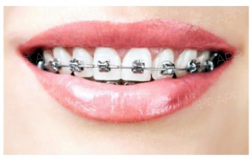 【正畸人士必看】3种牙齿矫正器的区别是什么？