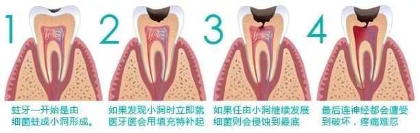 牙疼为什么要抽掉牙神经？