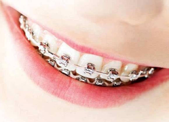 今日高考，改变人生的不只高考，还有牙齿矫正