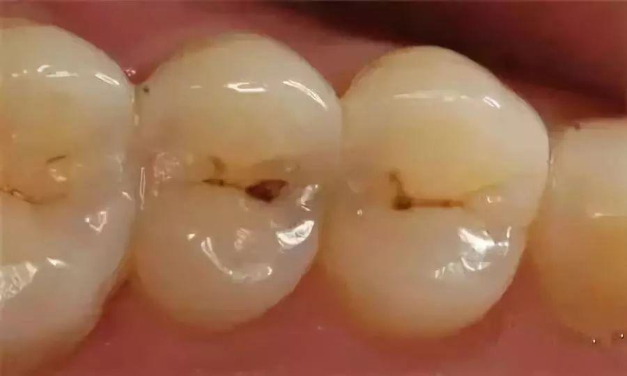 孩子牙齿变黑就是蛀牙吗？