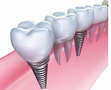种植牙是什么？为什么它是缺牙人的首选？