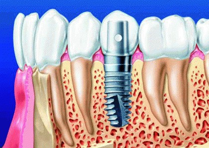 拔牙后多久可以做种植牙？