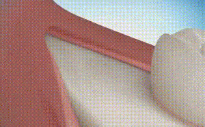 智齿疼到底该不该拔牙？这8种情况不能耽误！