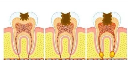 为什么我的牙白天不痛，夜晚痛？
