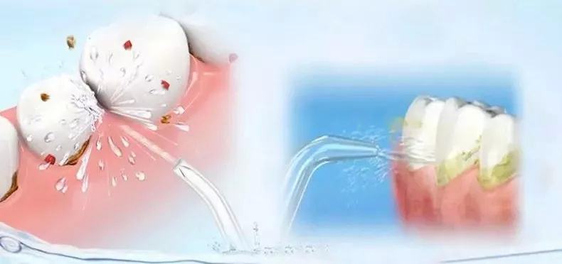 关于洗牙的7大疑问，一次为你解答清楚！