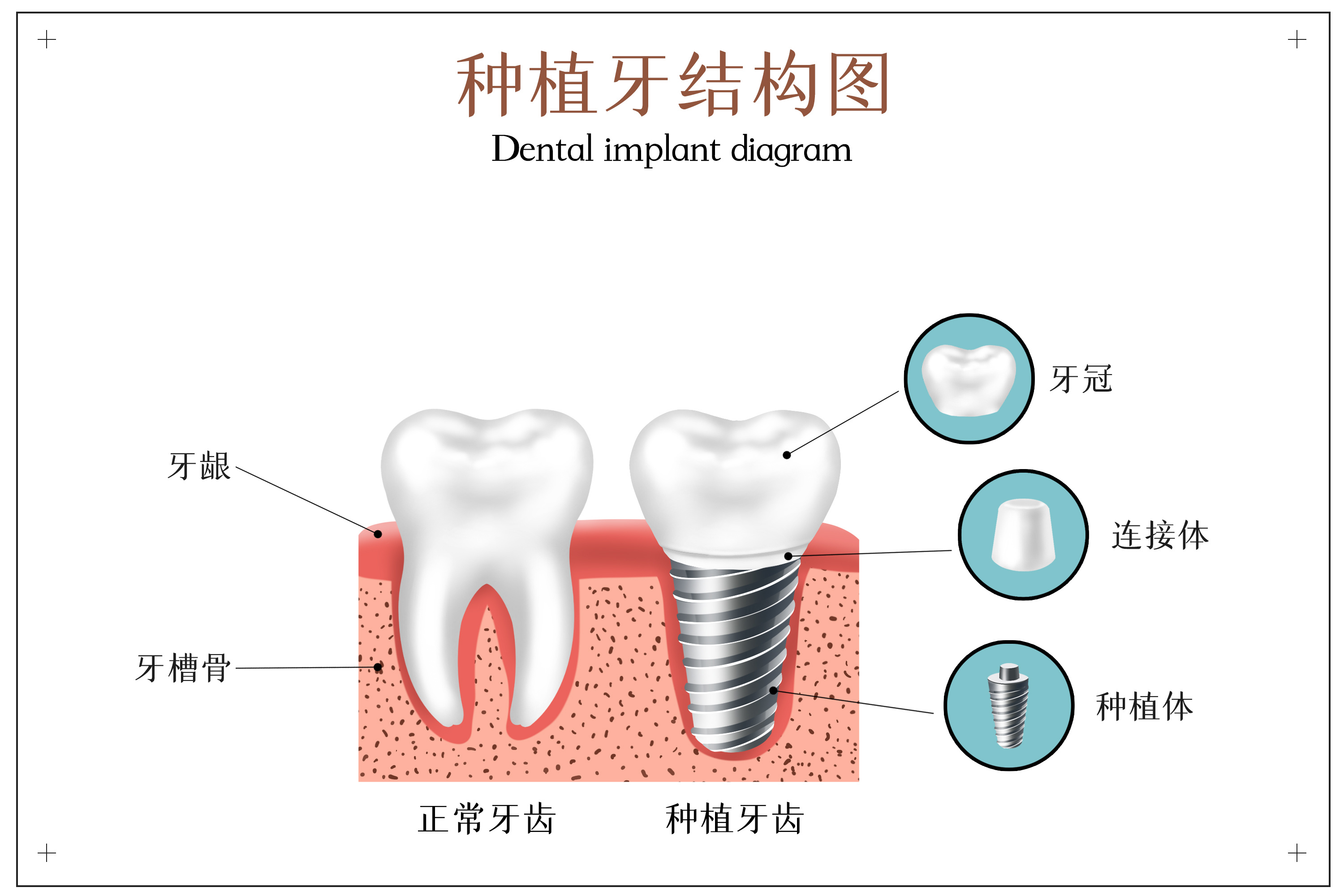 摄图网_401804175_种植牙结构示意图(非企业商用).jpg